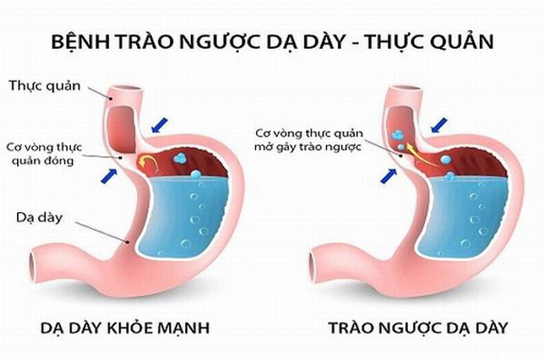 Dù đã sử dụng nhiều loại thuốc nhưng bệnh trào ngược dạ dày vẫn không thuyên giảm